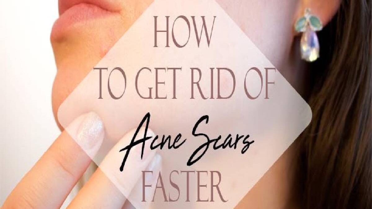 How to Get Rid of Acne Scars? – Hydroquinone, Retinoids, and More