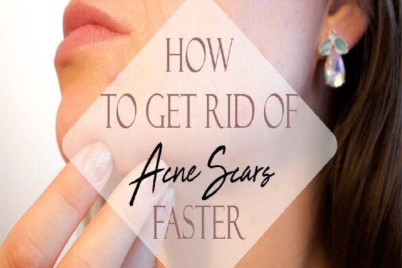 how to get rid of acne scars