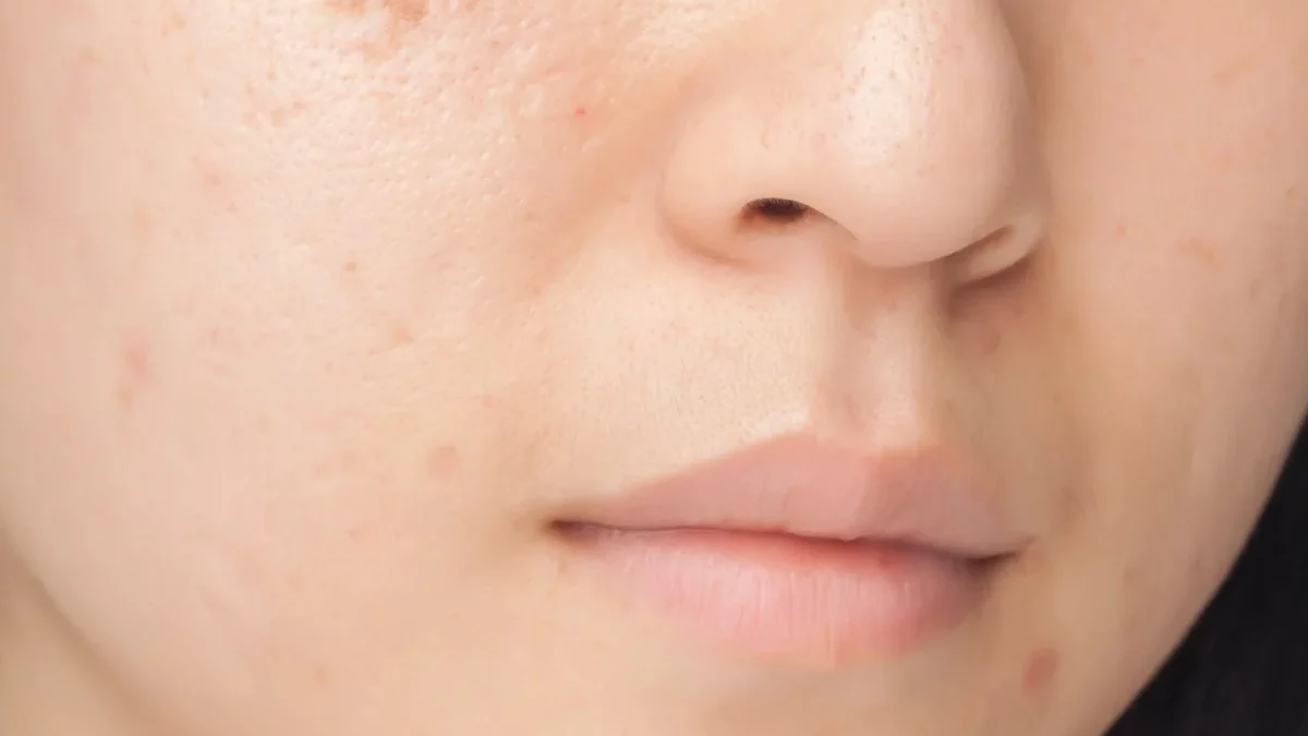 Red Mark From Acne – Past Acne Marks, Treatment of Red Marks, and More